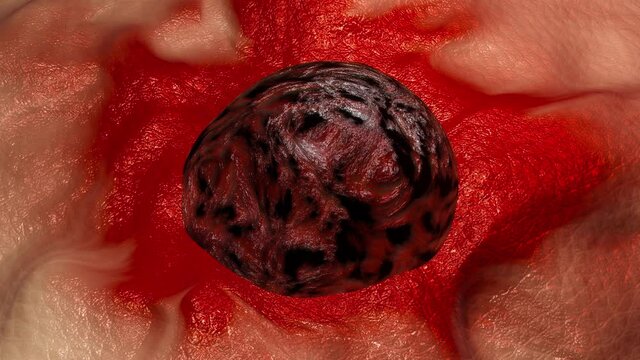 3D animation of a close-up of a growing skin cancer like the malign melanoma inflaming surrounding tissue.