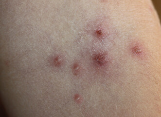 chickenpox close up 