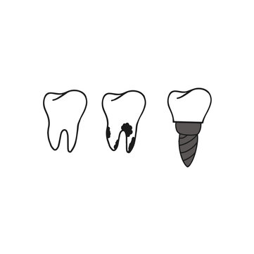 Healthy tooth, tooth affected by caries and implant. Hand drawn dental implant structure medical ,teeth and tooth concept of dental. Vector illustration