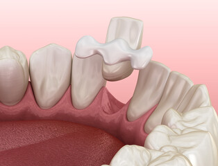 Maryland bridge made from ceramic, frontal tooth recovery. Medically accurate 3D illustration of dental concept