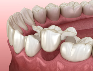 Maryland bridge made from ceramic, premolar tooth recovery. Medically accurate 3D illustration of dental concept