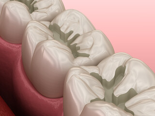 Prepareted Molar Fissure for fillings placement, Medically accurate 3D illustration of dental concept