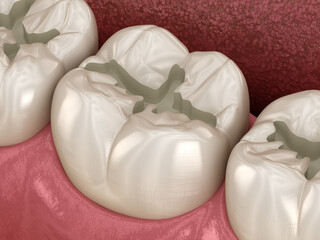 Fototapeta na wymiar Prepareted Molar Fissure for fillings placement, Medically accurate 3D illustration of dental concept