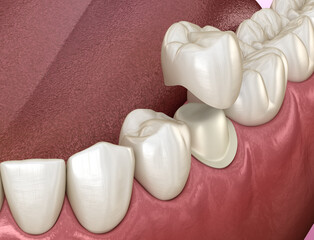 Preparated premolar tooth and dental metal-ceramic crown. Medically accurate 3D illustration