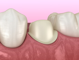 Preparated premolar tooth for dental metal-ceramic crown placement. Medically accurate 3D illustration
