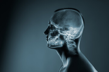X-ray of a man's head. Medical examination of head injuries.