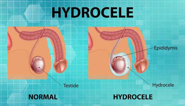 Medical poster showing different between male normal testicle and hydrocele