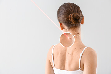 Young woman undergoing procedure of nevus removal by laser on light background - obrazy, fototapety, plakaty
