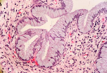 Mucus producing glands within a cervix poyp. The tissue contains various immune cells including plasma cells. Microscopic view.