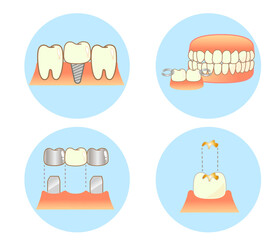 Implant Caries and Progression and Treatment: Dental Illustration