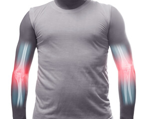 Close up front view of a young man showing his elbow in pain with x-ray elbow, isolated on white background. Lower arm pain. Shirtless man his elbow for the pain.