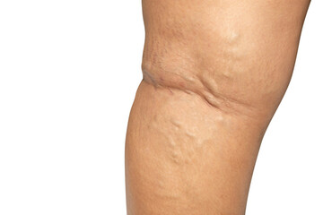 Varicose veins on a severely affected leg. The old age and sick of a woman. Isolated on white background and clipping path.