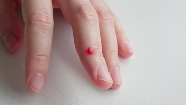 A gel-like red blood clot at the site of a cut on a woman's middle finger, the final stage of coagulation preceding the restoration of damaged walls of blood vessels and skin cells.