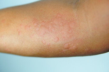 Close up Allergy Rash on sensitive skin