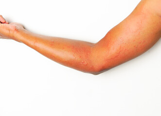 Close up Allergy Rash on sensitive skin