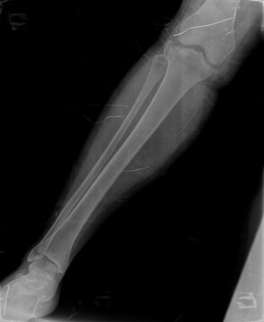 Broken x ray image of leg
