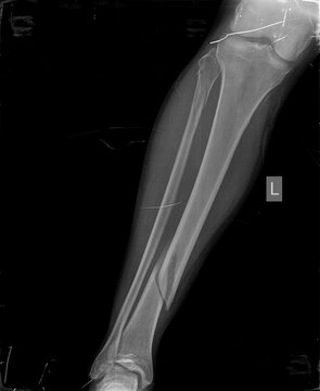 Broken x ray image of leg