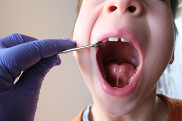 dentist, doctor examines oral cavity of small patient, length of frenum of the tongue, boy, kid...