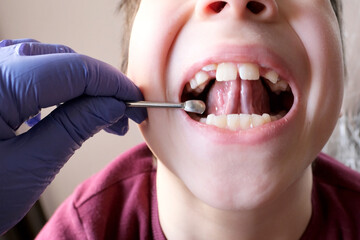 dentist, doctor examines oral cavity of small patient, length of frenum of the tongue, boy, kid performs articulation exercises for mouth, concept of speech disorders, correction