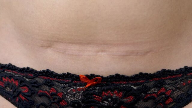 Female hand touch belly after surgery or operation. Caesarean section also known as C-section or caesarean delivery. Scar after deliver babies. Skin care after pregnancy time