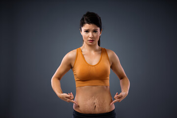 Young mum standing and pointing at her belly full of stretch marks after pregnancy.