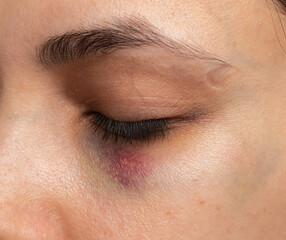 Fototapeta na wymiar hematoma under the eye on the skin as a background