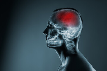 X-ray of a man's head. Cerebral stroke. Brain damage is highlighted by red colour.