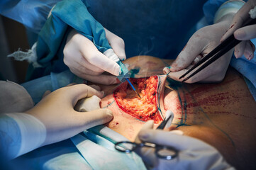 Close up of plastic surgeon and assistants doing plastical surgical operation in hospital, using...