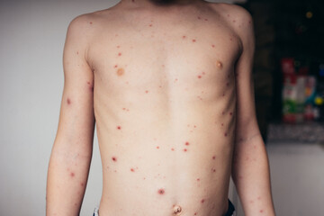 chickenpox in a child, rash. selective focus