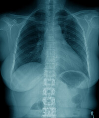 chest x-ray image in blue tone