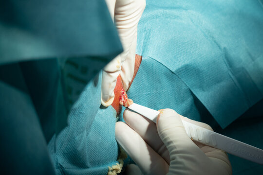  surgeon opens a large abscess with a scalpel in a hospital