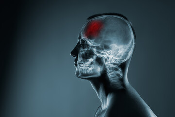X-ray of a man's head. Medical examination of head injuries. Frontal part of the brain is...