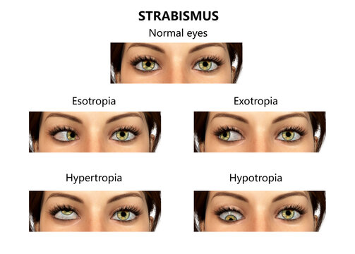Strabismus, eyes deviation, illustration