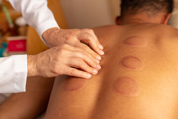 Terapeuta fazendo massagem nas costas de paciente com marcas de terapia com ventosa.
