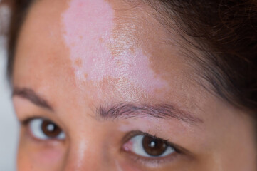 Close-up of a woman with autoimmune pigmentation disease vitiligo