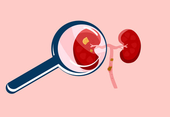 Scrutiny Kidney stone with magnifying glass.Nephrology.Pyelonephritis and renal failure disease.Inflammation in organ,cystitis chronic illness.Problem with filtration,dialysis.Vector in flat style