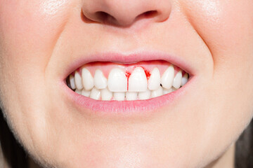 Close up of woman mouth with bleeding gums