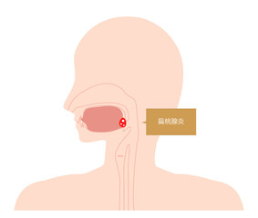 扁桃腺炎　炎症イラスト