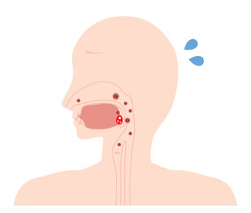 扁桃腺炎　炎症イラスト