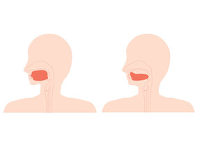 正しい舌の位置と低位舌のイラスト