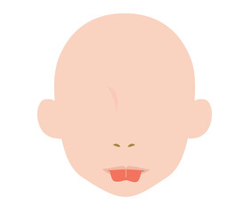 舌小帯短縮症で舌を伸ばすとハート型になるイラスト