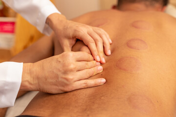 Fototapeta na wymiar Close em mãos de terapeuta fazendo massagem em costas de paciente que está com marcas de ventosas.