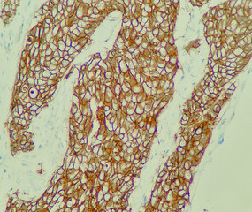 Photo of breast cancer shows positive result of HER2 stain, photo under microscope, magnification...