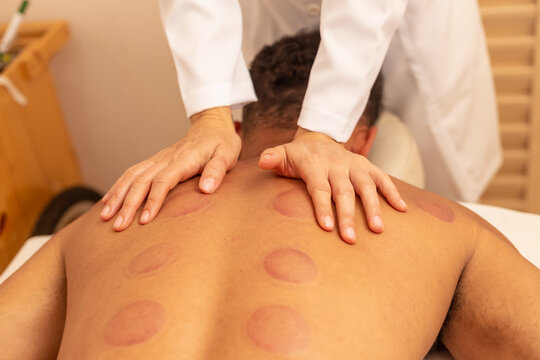 Close em m&atilde;os de terapeuta fazendo massagem em costas de paciente que est&aacute; com marcas de ventosa.