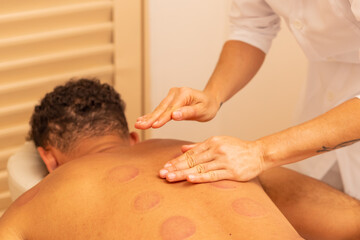 Obraz na płótnie Canvas Close em mãos de terapeuta fazendo massagem em costas de paciente que está com marcas de ventosa.