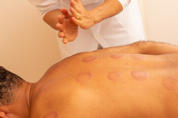Close em mãos de terapeuta fazendo massagem em costas de paciente que está com marcas de ventosa.