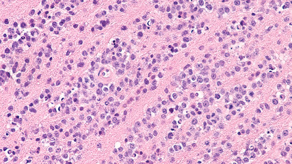 Lymphoma involving brain: photomicrograph of a diffuse large B cell lymphoma (DLBCL)  showing invasion by tumor cells of the cerebral cortex. 