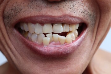 Obraz premium Asian man smiling with yellow teeth and stacked disorganized.