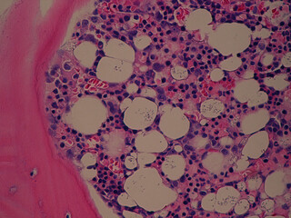 Bone marrow core biopsy pathology - Histoplasma disseminated infection