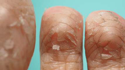 Close up of Foot peeling or remove dead skin on green or tiffany blue background.
